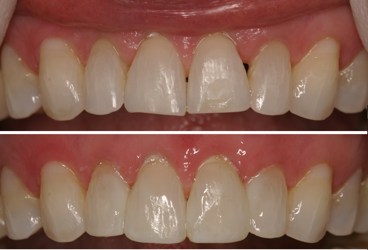 Partial-Denture