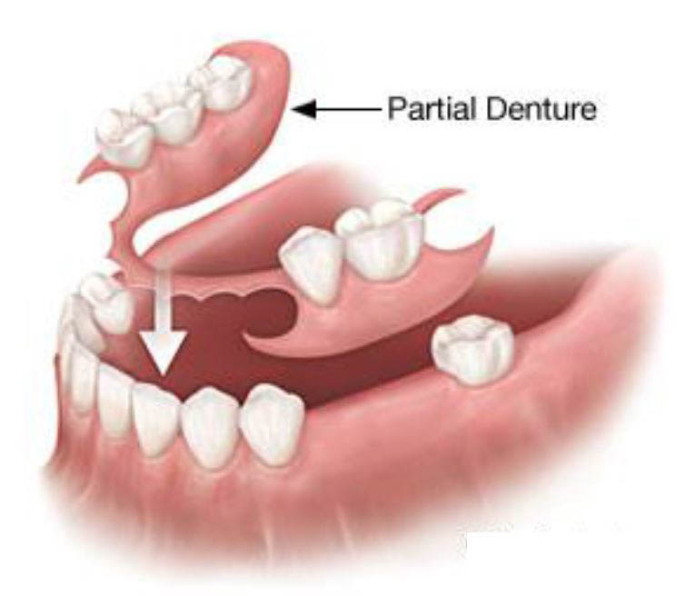 Partial-Denture