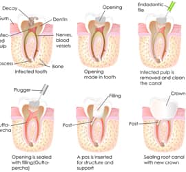 Partial-Denture