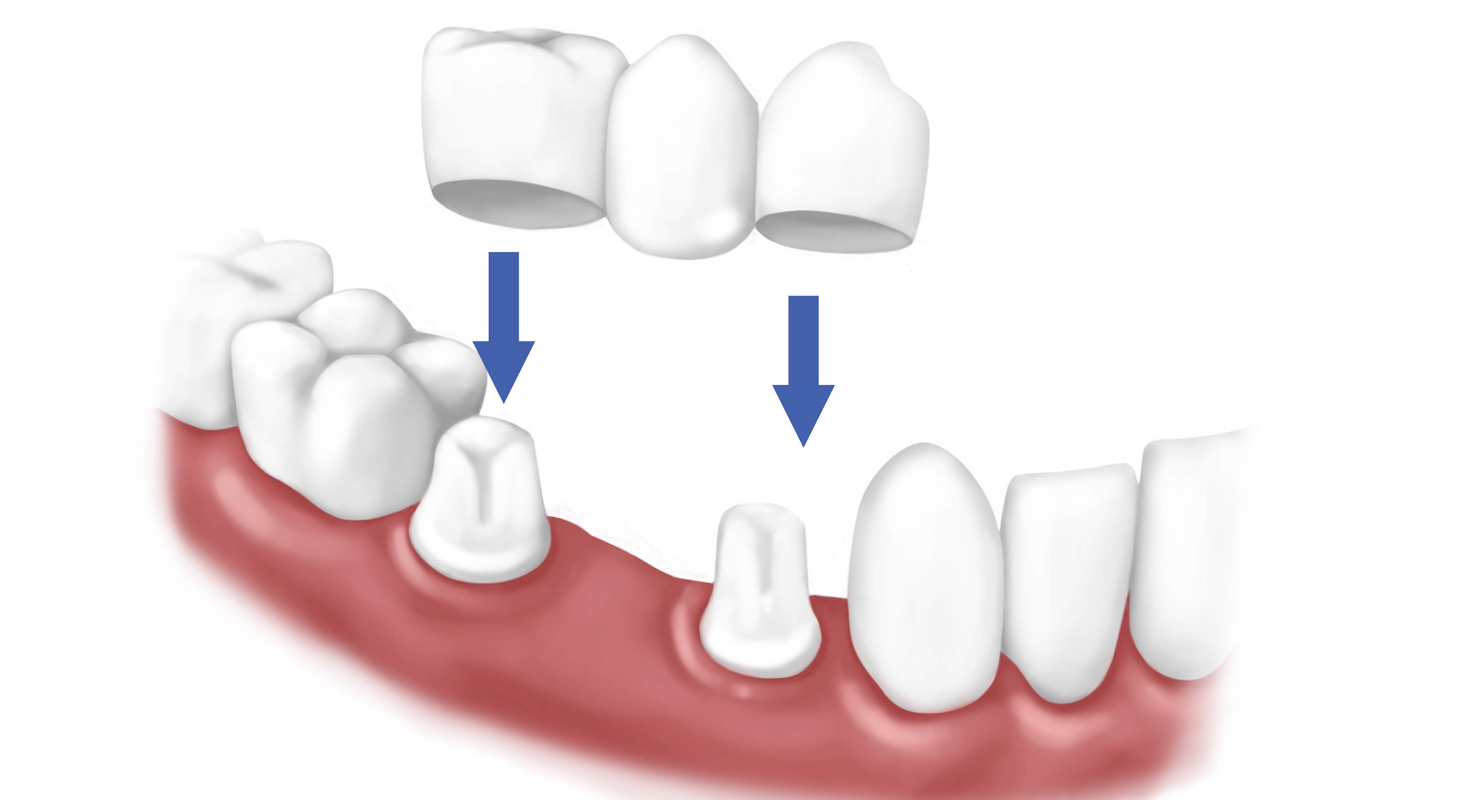 Partial-Denture